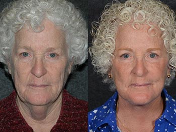 Beverly Hills Center Female Patient Before and After Face and Neck Rejuvenation Procedure