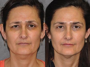 Beverly Hills Center Female Patient Before and After Facial Procedure