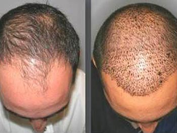 Beverly Hills Center Male Patient Before and After Hair Translplant