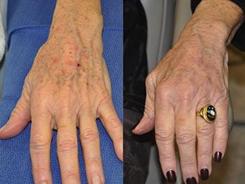 Beverly Hills Center Female Patient Before and After Hand Rejuvenation