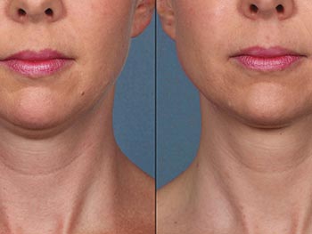 Beverly Hills Center Female Patient Before and After Neck Kybella Injections