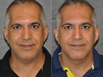 Beverly Hills Center Male Patient Before and After Laser Facelift