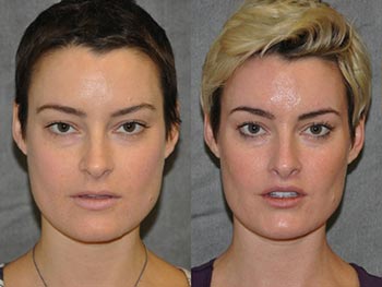 Beverly Hills Center Female Patient Before and After Lip Procedures