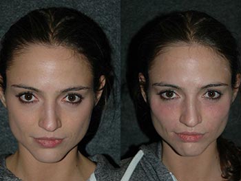 MODELS & ACTORS - Before and After Gallery