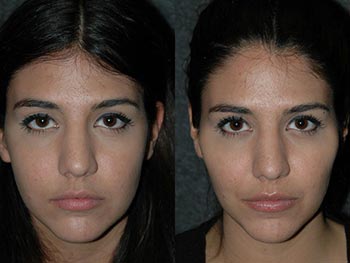 Beverly Hills Center Female Patient Before and After Non-surgical Facial Procedures