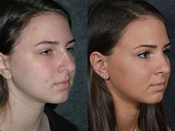 Beverly Hills Center Female Patient Before and After Nose Procedure