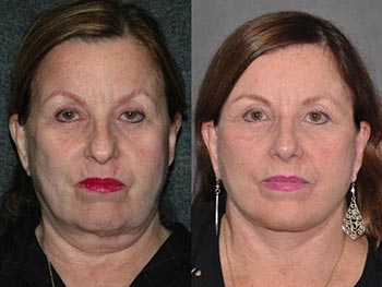 Beverly Hills Center Female Patient Before and After Revision Plastic Surgery
