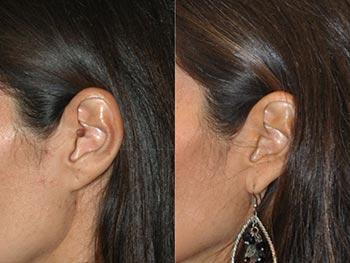 Beverly Hills Center Female Patient Before and After Mole Removal