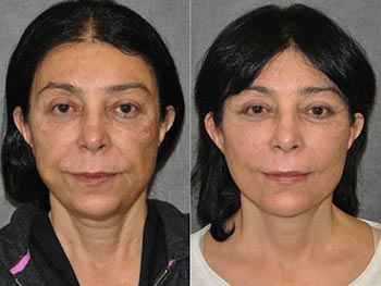 Beverly Hills Center Female Patient Before and After Skin Rejuvenation Procedures