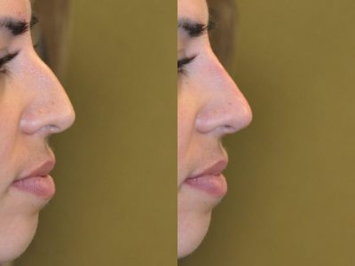 Non Surgical, Liquid Rhinoplasty / Nosejob