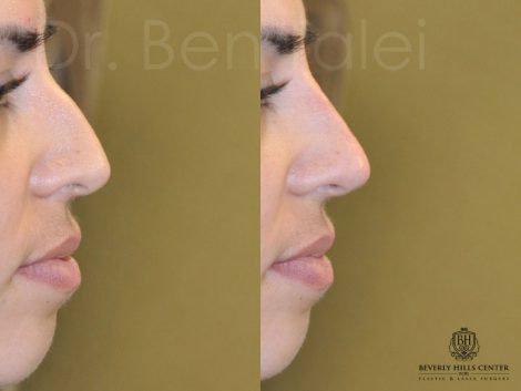 Non Surgical, Liquid Rhinoplasty / Nosejob