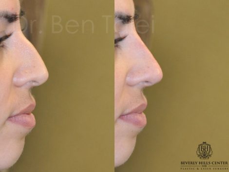 Non Surgical, Liquid Rhinoplasty / Nosejob