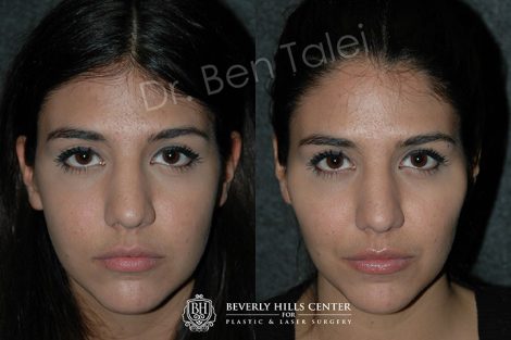 Beverly Hills Center Female Patient Before and After Non-surgical Cheek Augmentation