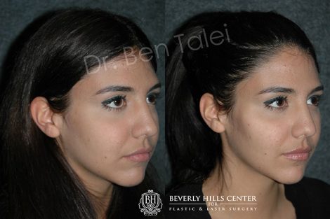 Beverly Hills Center Female Patient Before and After Non-surgical Cheek Augmentation