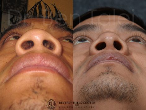 Beverly Hills Center Male Patient Before and After Rhinoplasty Procedure