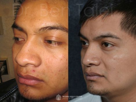 Beverly Hills Center Male Patient Before and After Rhinoplasty Procedure