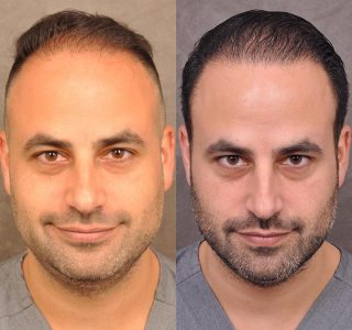 Dr. Ben Talei himself at the 8 months post-op mark