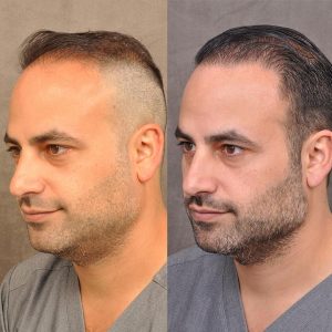 Dr. Ben Talei himself at the 8 months post-op mark
