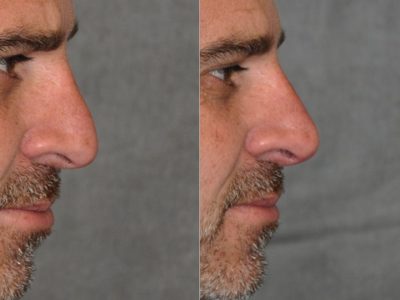 Non Surgical, Liquid Rhinoplasty / Nosejob