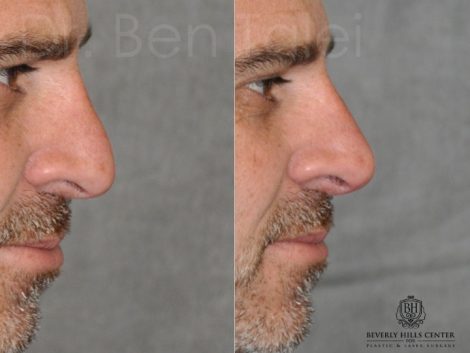 Non Surgical, Liquid Rhinoplasty / Nosejob