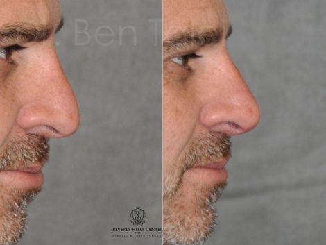 Non Surgical, Liquid Rhinoplasty / Nosejob