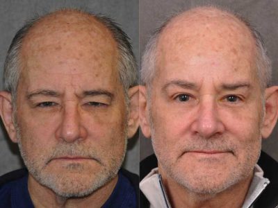 Brow & Eyelid Ptosis Repair with Lower Eyelid Rejuvenation - Front