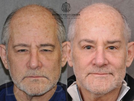 Brow & Eyelid Ptosis Repair with Lower Eyelid Rejuvenation - Front