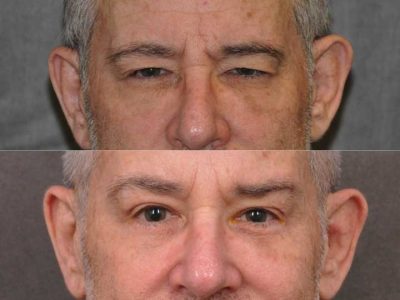 Brow & Eyelid Ptosis Repair with Lower Eyelid Rejuvenation - Front