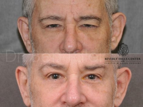 Brow & Eyelid Ptosis Repair with Lower Eyelid Rejuvenation - Front