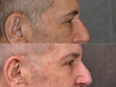 Brow & Eyelid Ptosis Repair with Lower Eyelid Rejuvenation - Right Side