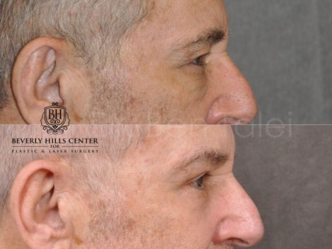 Brow & Eyelid Ptosis Repair with Lower Eyelid Rejuvenation - Right Side