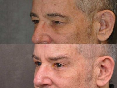 Brow & Eyelid Ptosis Repair with Lower Eyelid Rejuvenation - Left Side