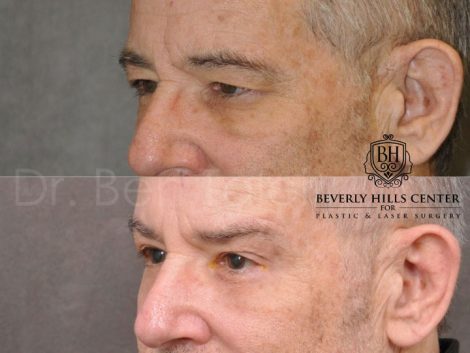 Brow & Eyelid Ptosis Repair with Lower Eyelid Rejuvenation - Left Side