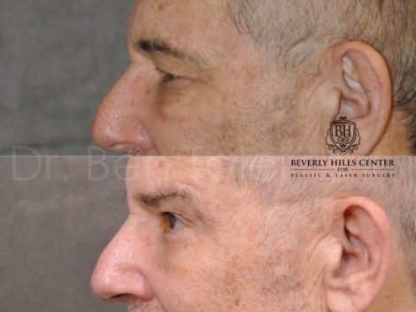 Brow & Eyelid Ptosis Repair with Lower Eyelid Rejuvenation - Left Side