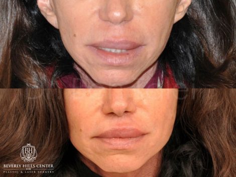 Modified Upper Lip Lift - Front