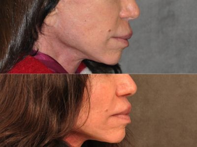 Modified Upper Lip Lift - Right Side
