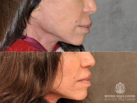 Modified Upper Lip Lift - Right Side