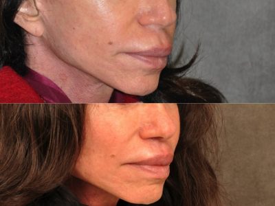 Modified Upper Lip Lift - Right Side