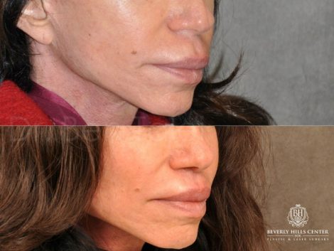 Modified Upper Lip Lift - Right Side