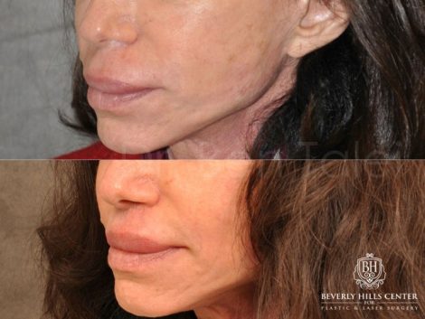 Modified Upper Lip Lift - Left Side