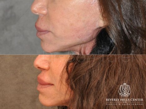 Modified Upper Lip Lift - Left Side