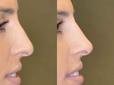Non Surgical Rhinoplasty