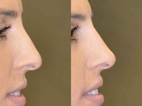 Non Surgical Rhinoplasty