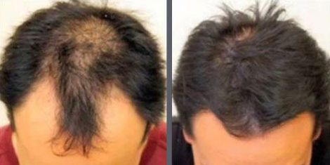 Hair Transplant with NeoGraft.