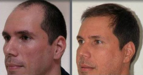 Hair Transplant with NeoGraft.