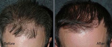 Hair Transplant using the thin strip method.
