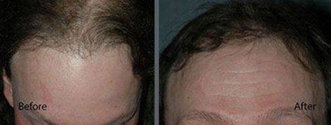 Hair Transplant using the thin strip method.