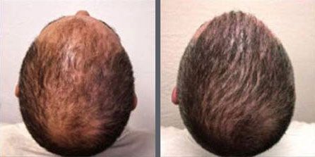 Hair Transplant with NeoGraft.