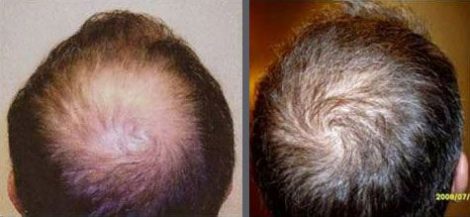 Hair Transplant with NeoGraft.