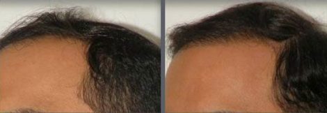 Hair Transplant using the thin strip method.